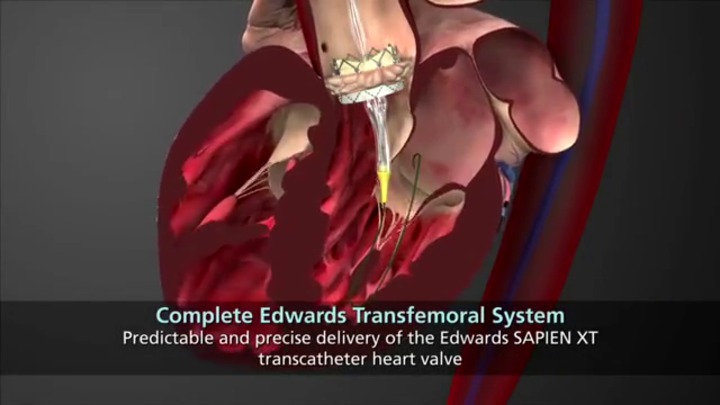 Remplacement de valves pulmonaires et endocardites infectieuses : quel  risque avec la valve SAPIEN ? - MediQuality